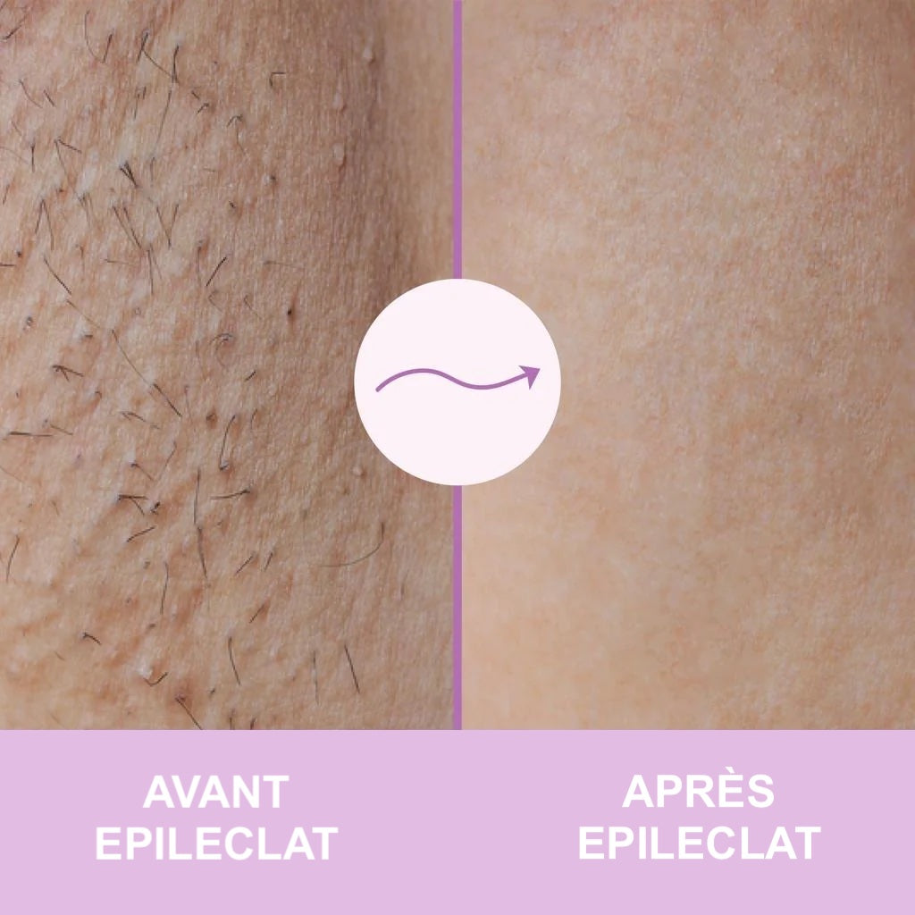 EPILECLAT™ 